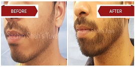 beard-transplant-3