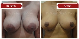 breast-lift-surgery-1