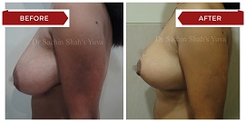 breast-lift-surgery-2