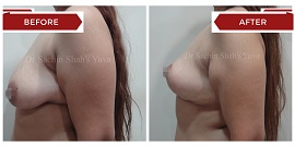breast-lift-surgery-4