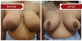 breast-reduction-1