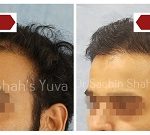 hair-transplant-1