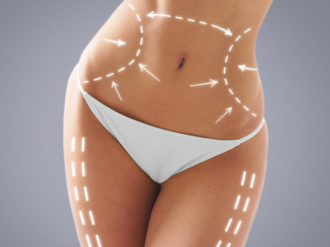 Liposuction-1
