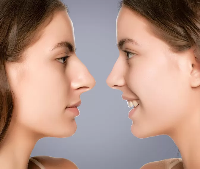 Rhinoplasty-2 Rhinoplasty-2