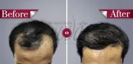 Yuva-hair-transplant-results