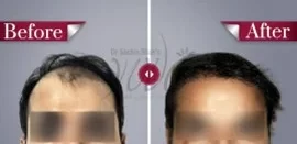 Yuva-hair-transplant-results2