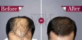 Yuva-hair-transplant-results3