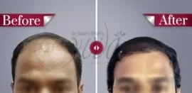 Yuva-hair-transplant-results4