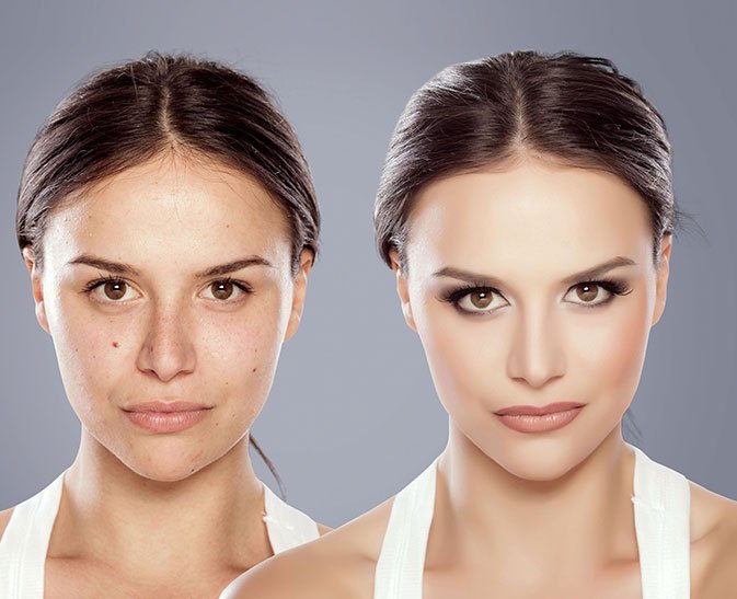 facial-implants